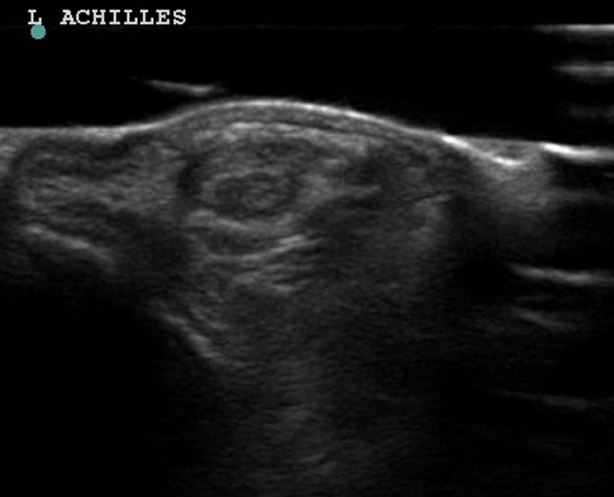 Image for Evaluation of Achilles Tendon Injuries with Findings from Diagnostic Musculoskeletal Ultrasound in Canines – 43 Cases